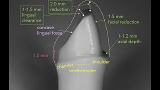 Anterior PFM Preparation  Dr Richard Stevenson [upl. by Atikal]