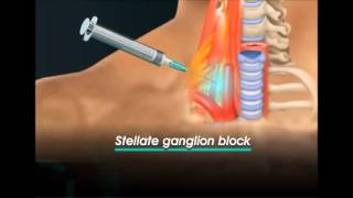 stellate ganglion block [upl. by Jose]