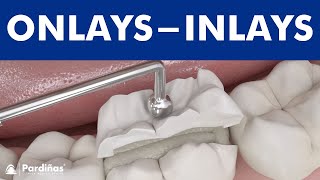 Dental inlays and onlays © [upl. by Clay]