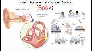 Treatment for vertigo BPPV Exercises Self Exercises For Vertigo AT HOME How To Treat Vertigo [upl. by Osrit]