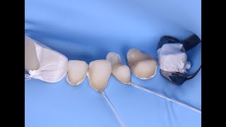 Multiple OnlaysVeneers adhesive cementation [upl. by Pacorro]