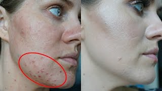 I GOT RID OF ACNE  Manuka honey experiment 8 days WORKED [upl. by Loggia]