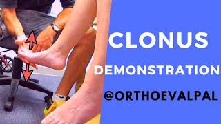 Clonus Demonstration with Ortho Eva Pal [upl. by Ahsemit946]