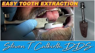 Easy Tooth Extraction  Dental Minute with Steven T Cutbirth DDS [upl. by Ireg]