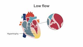 Diagnosing paradoxical low flow [upl. by Trawets]