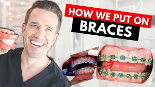 How Braces are Put On  Part IV Dr Nate [upl. by Columbyne]