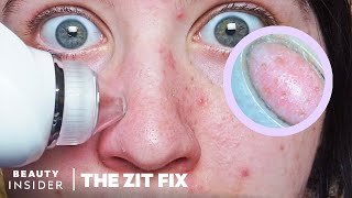 Pore Vacuum For Blackheads Has BuiltIn Microscope  The Zit Fix [upl. by Nalim33]