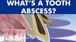 TOOTH ABSCESS dental infection  PHLEGMON symptoms and treatment © [upl. by Ayamat]