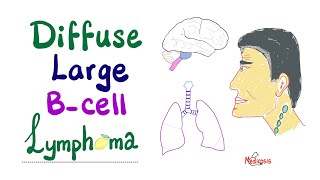 Diffuse Large BCell Lymphoma DLBCL  Aggressive BCell Neoplasm  NonHodgkin’s Lymphoma [upl. by Airamas]