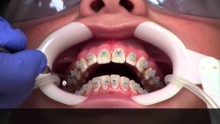 Getting Braces  How [upl. by Sikata]