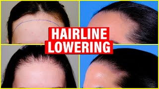 Hairline Lowering Hair Transplant vs Surgical Hairline Advancement [upl. by Caasi]