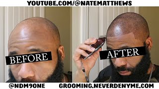 How To Get Your Hairline Back  From Bald To Edge Up  Hairline Restoration [upl. by Eillas134]