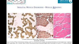 Treatment tips for inflammatory myopathy [upl. by Nabla99]