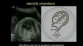 Efficient and Effective Interpretation of the Four Chamber Heart View and Views of the Great Arterie [upl. by Delsman903]