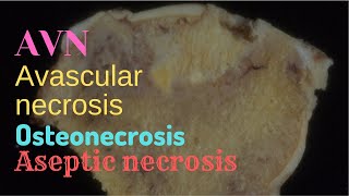 Avascular Necrosis  Pathology mini tutorial [upl. by Kevan]