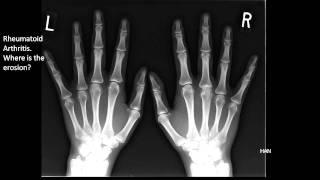 Osteomyelitis clinical features and diagnosis [upl. by Ajaj]