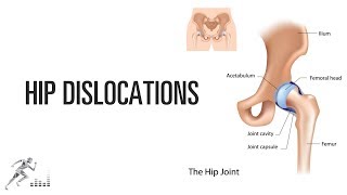 Hip dislocation [upl. by Saunderson952]