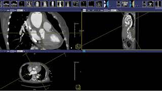 Laparoscopic Pelvic and Aortic Lymphadenectomy [upl. by Nirol293]