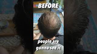 BALDING Man Gets A VIKINGS BUZZ CUT TRANSFORMATION [upl. by Almond]