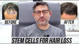 STEM CELL Hair Restoration 4 month Update [upl. by Akenna]