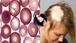 Grandmas SECRET Recipe for Hair growth in 15 days Onion Juice And Coconut Oil Pack treatment [upl. by Mas]