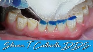 Bonding Worn Anterior Teeth  Dental Minute with Dr Steven T Cutbirth DDS [upl. by Humble]