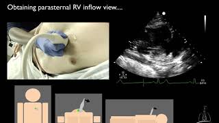 05 Right ventricular inflow amp outflow views [upl. by Ardnuaet154]