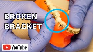 Broken Braces Broken Loose or Sliding Bracket What To Do [upl. by Huntlee]