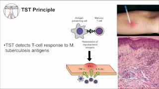 Tuberculosis Diagnosis [upl. by Porter]