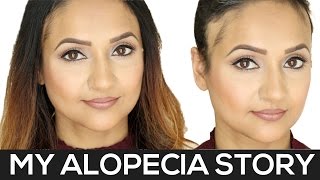 My Alopecia Story  Alopecia Areata [upl. by Idorb123]