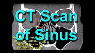 How To Read CT Sinus Scans Like An Expert [upl. by Haleigh]