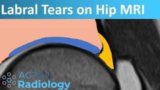 Labral Tears on Hip MRI [upl. by Ive958]