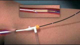 Animation of Endovenous Radiofrequency Ablation of Varicose Vein [upl. by Melamed589]