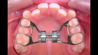 Rapid Palatal Expander [upl. by Carlos]