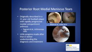 How To Test amp Heal A Meniscus Tear Without Surgery [upl. by Coad]