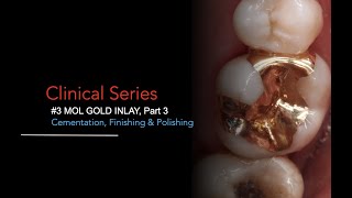 Gold Inlay Restoration Part 3 Cementation Finishing and Polishing [upl. by Massingill]