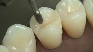 Class II Composite Preparation amp Restoration  Operative Dentistry [upl. by Fernandes950]