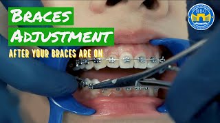 How Do Braces Straighten Teeth [upl. by China]