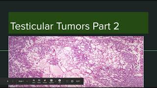 Yolk sac tumor and other tumors [upl. by Lonna]