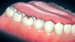 Dental Crowns Everything You Need to Know [upl. by Anuahsal]