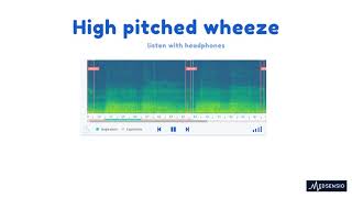 Lung sounds  high pitched wheeze [upl. by Udela]