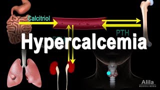 Hypercalcemia  Too Much Calcium Animation [upl. by Dianne]