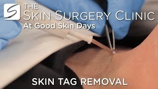 Skin Tag Removal  Watch the Procedure [upl. by Sliwa]