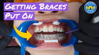 Process of Getting Braces [upl. by Deron]