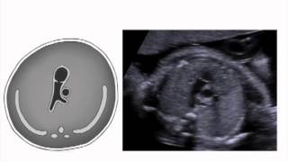 Right Ventricular Outflow Tract View of the Fetal Heart [upl. by Grindle381]