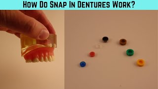 How do snap in dentures work A close look at implant retained overdenture snaps [upl. by Otsuaf]