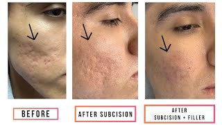 Subcision  Filler for Acne Scars [upl. by Charmine889]