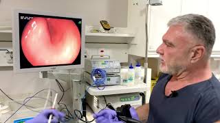 Endoscopia  Queixa de Dor Abdominal Azia e Vômito [upl. by Etnahs]