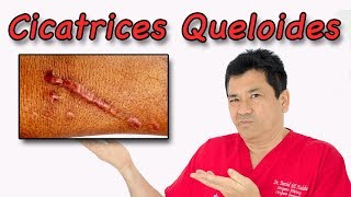 ¿Qué son las Cicatrices Queloides y cómo Tratarlas [upl. by Auburn]