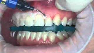 Why a gingival mask  Gum Protection [upl. by Waneta]